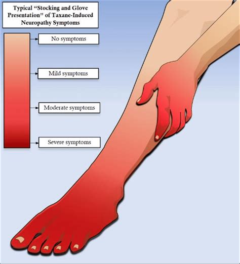 Stocking & Glove Neuropathy